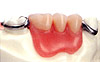 水野歯科クリニック　入れ歯　マグネット式　従来の義歯